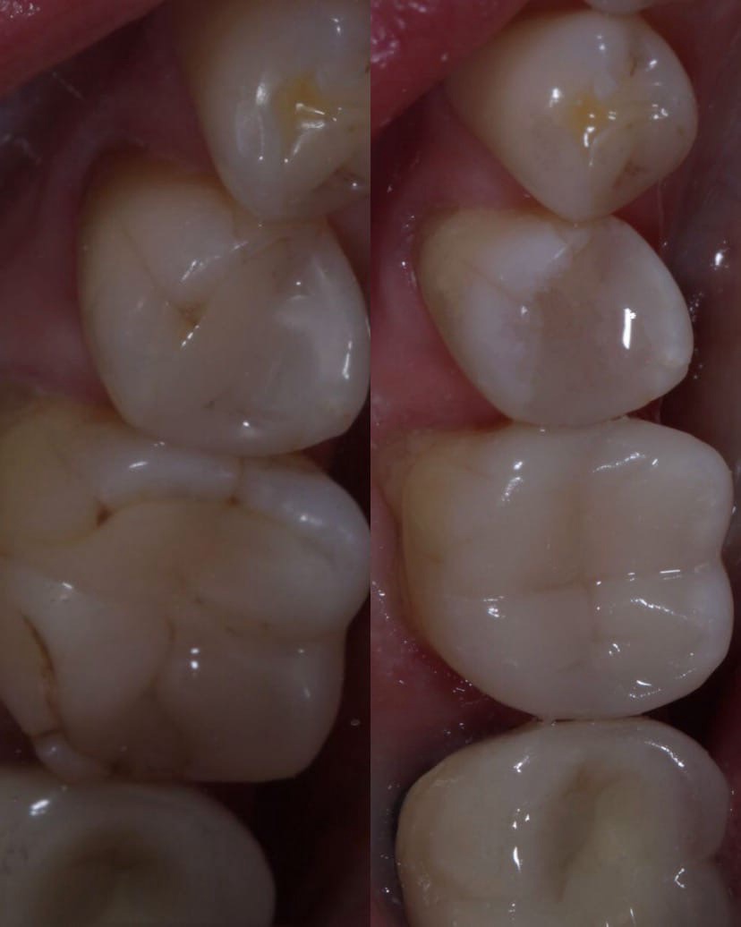 Бурдюжа Ю.А., Лечение кариеса и реставрация зуба