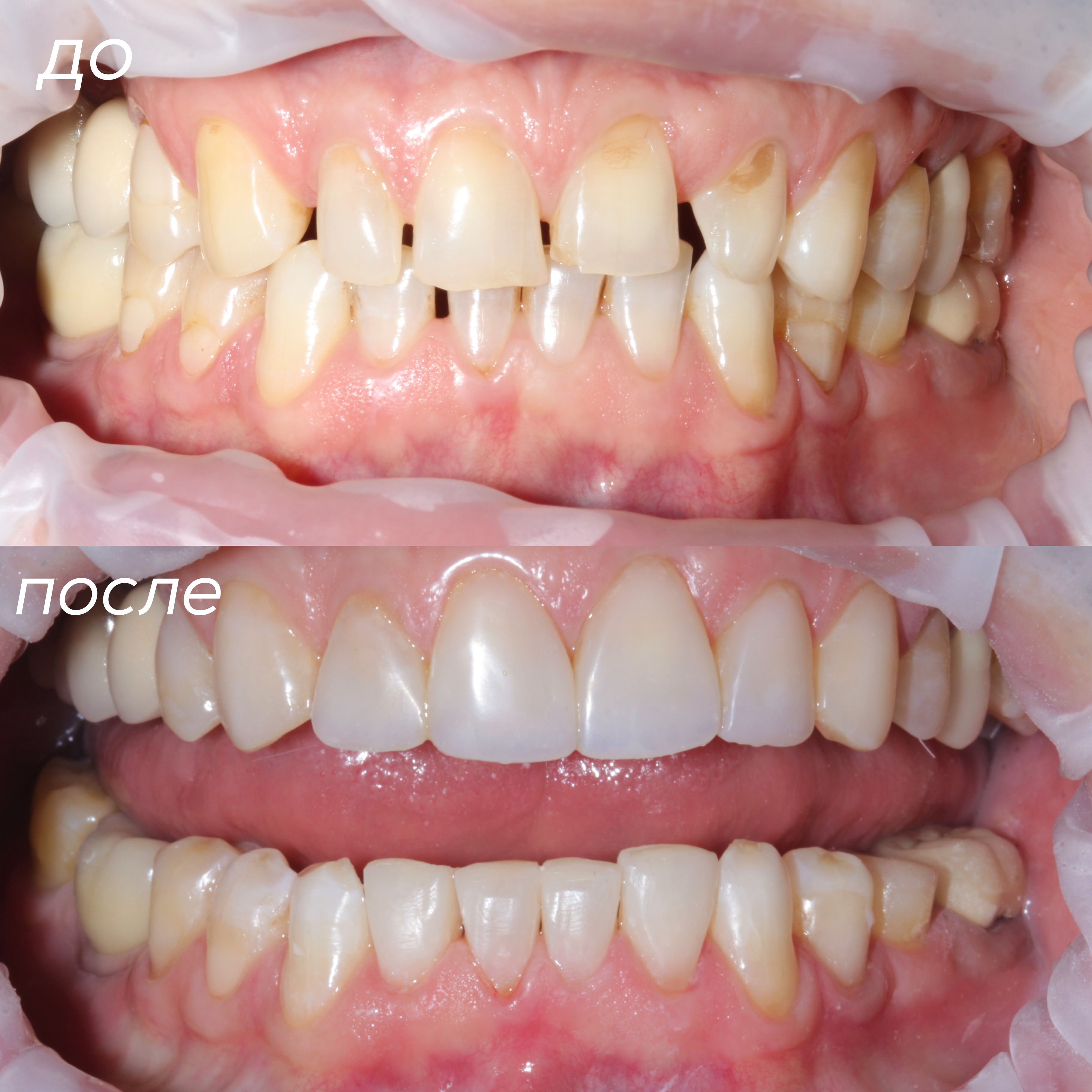 Гавриленко И.С. , Закрытие диастем (щели между передними зубами) с помощью художественной реставрации 