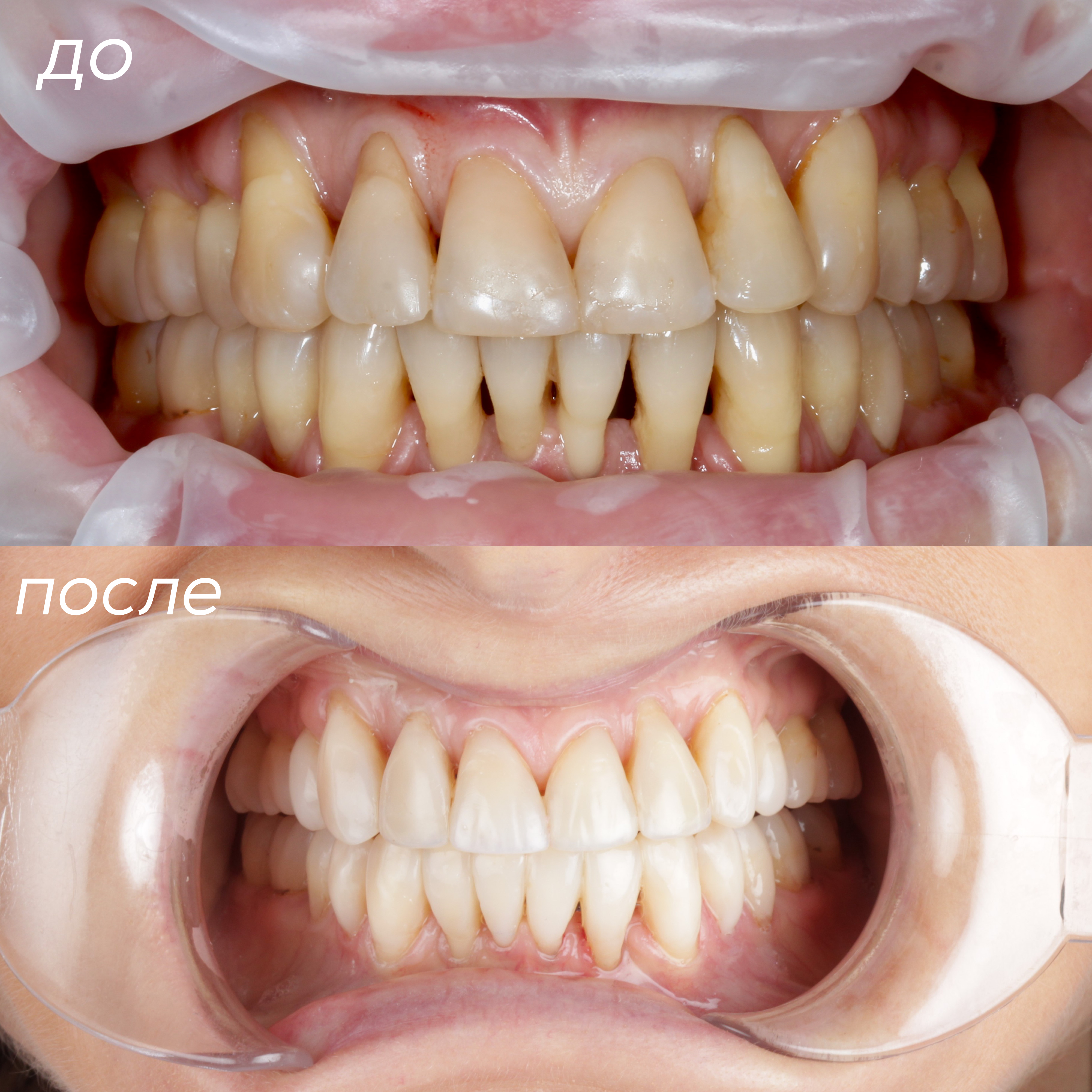 Гавриленко И.С., Фронтальная реставрация верхних и нижних зубов 