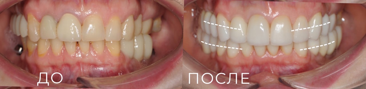 Баишев Т.Р., Имплантация зубов