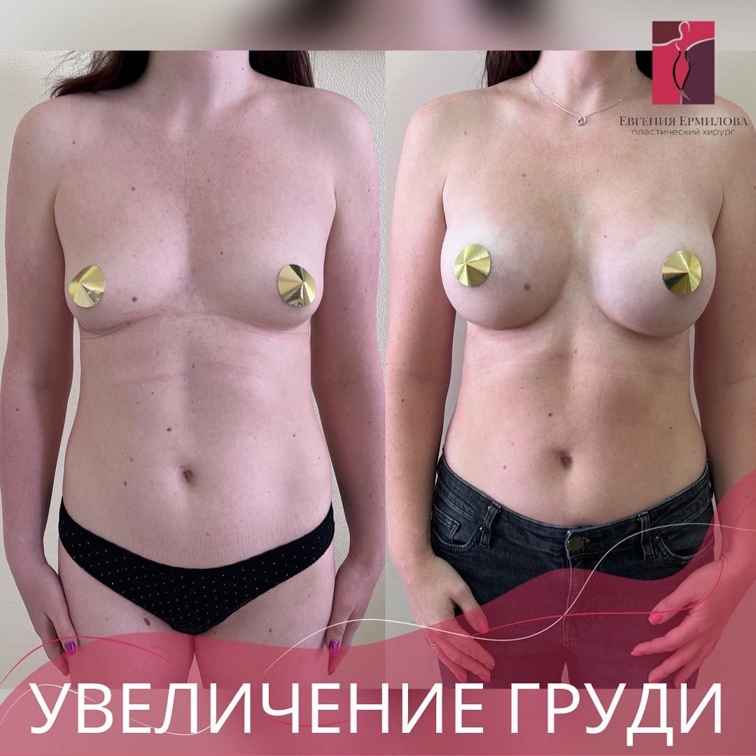 Ермилова Е.В., Увеличение груди 