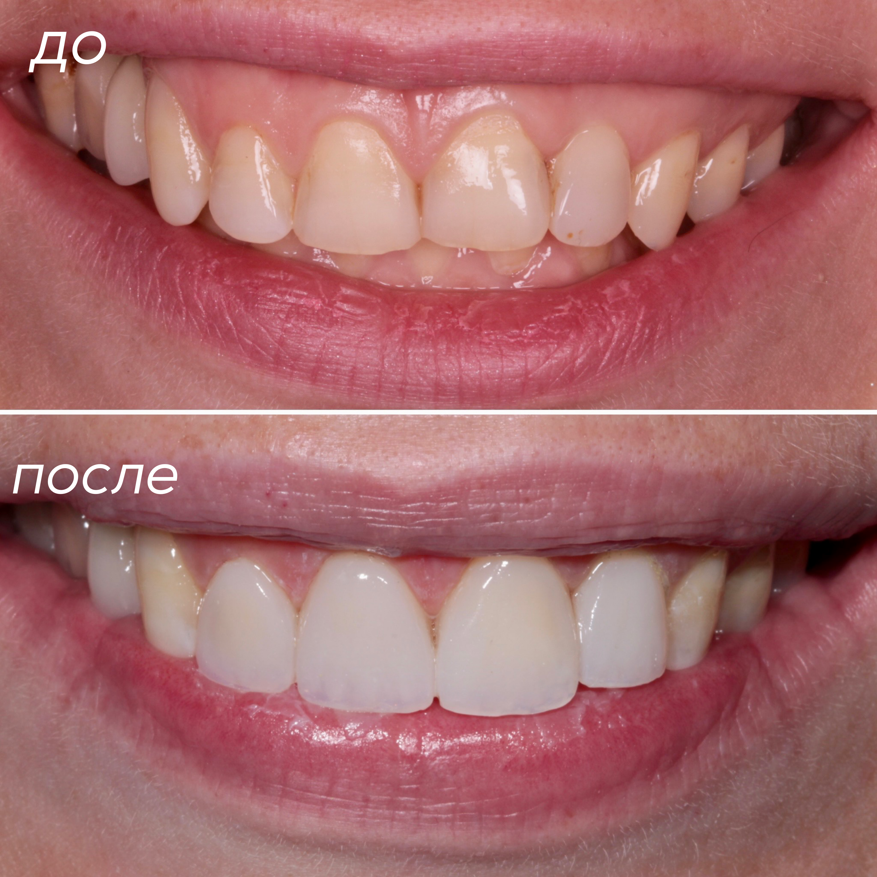 Гавриленко И.С. , Реставрация 4-х верхних зубов с помощью композитного материала 