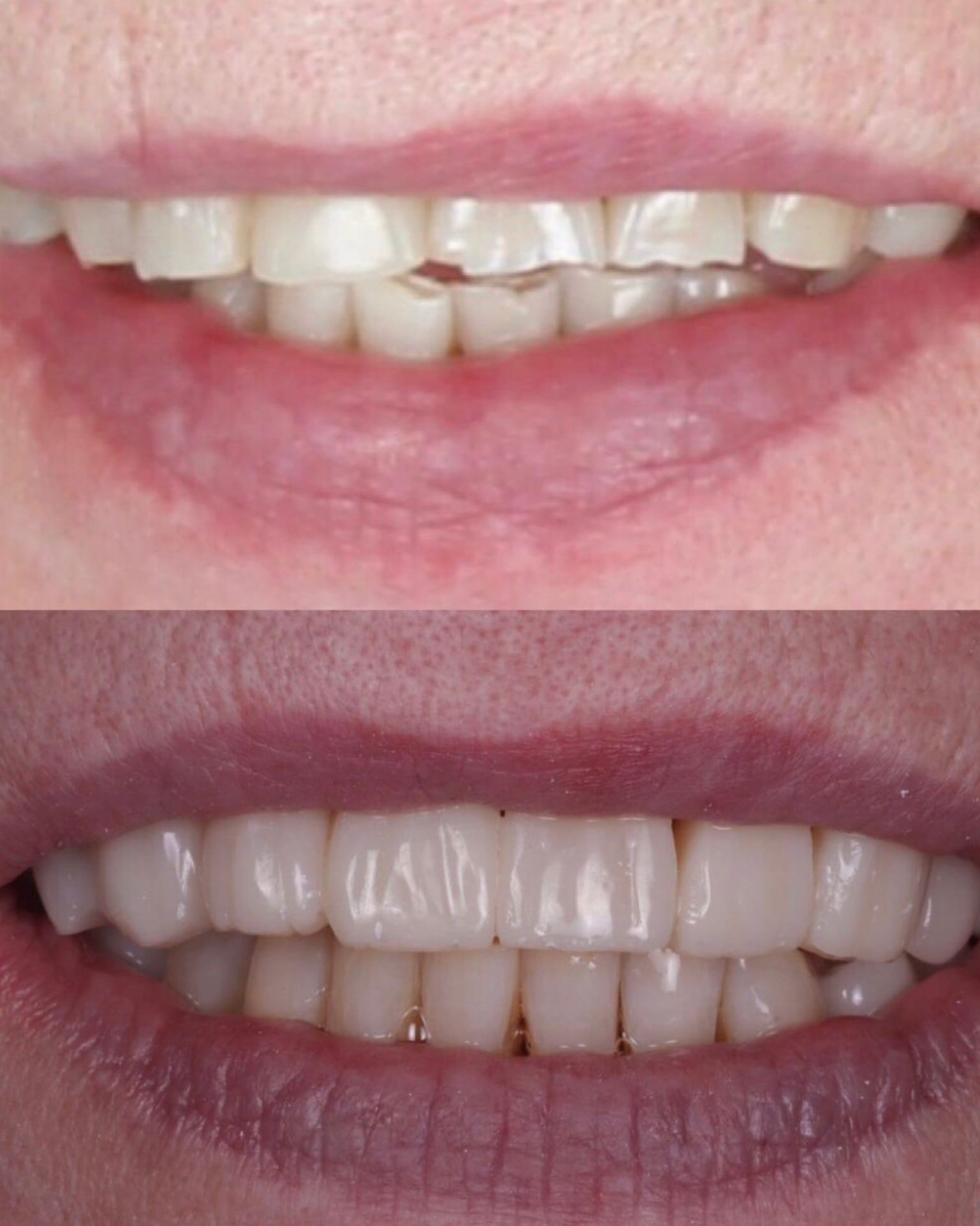 Бурдюжа Ю.А., Реставрация передних зубов