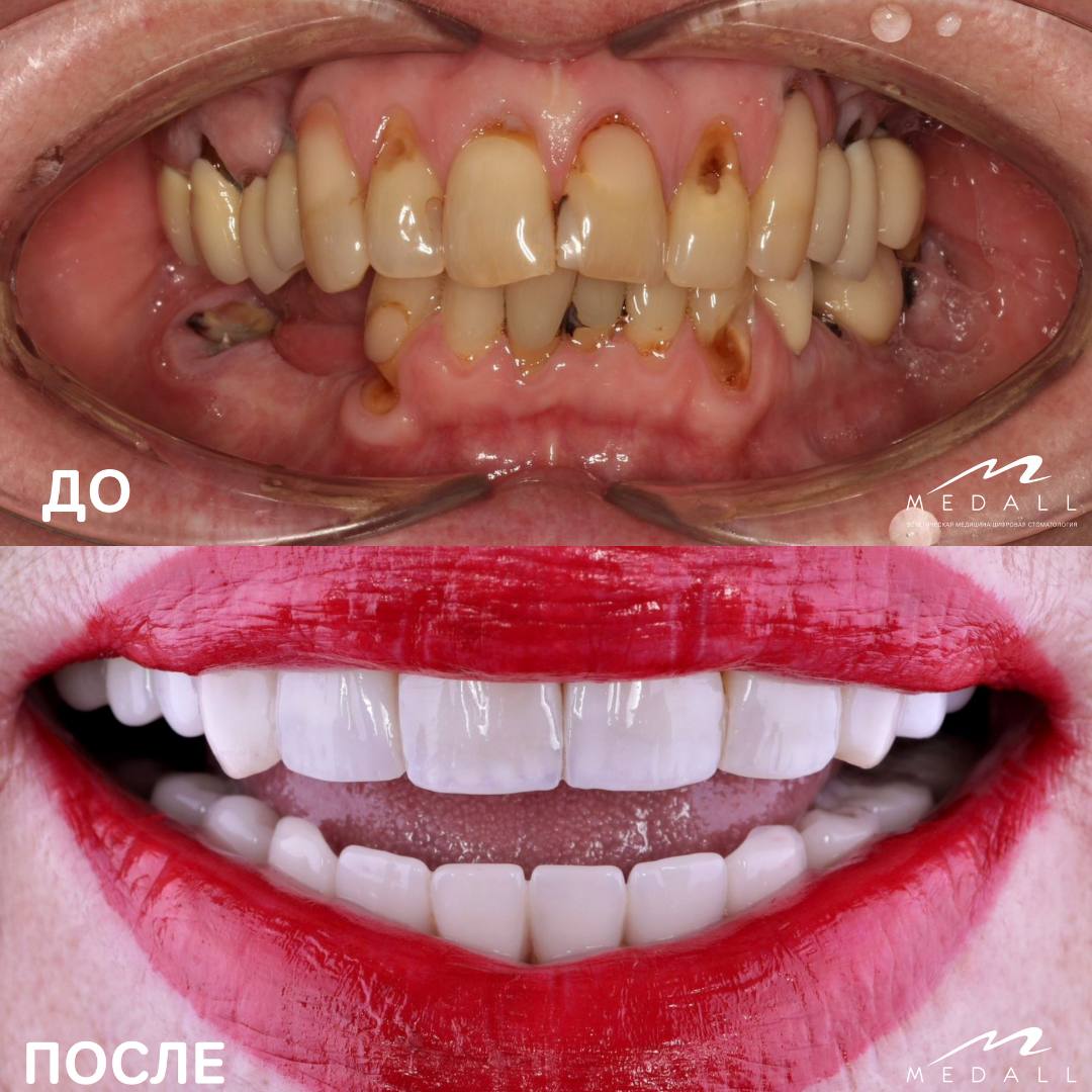 Гавриленко И.С. , Художественная эстетическая реставрация 6 верхних зубов  и протез на нижней челюсти 