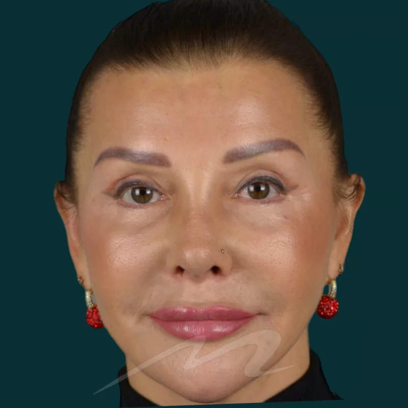 Септопластика, ринопластика (пластика носа), пьезоринопластика